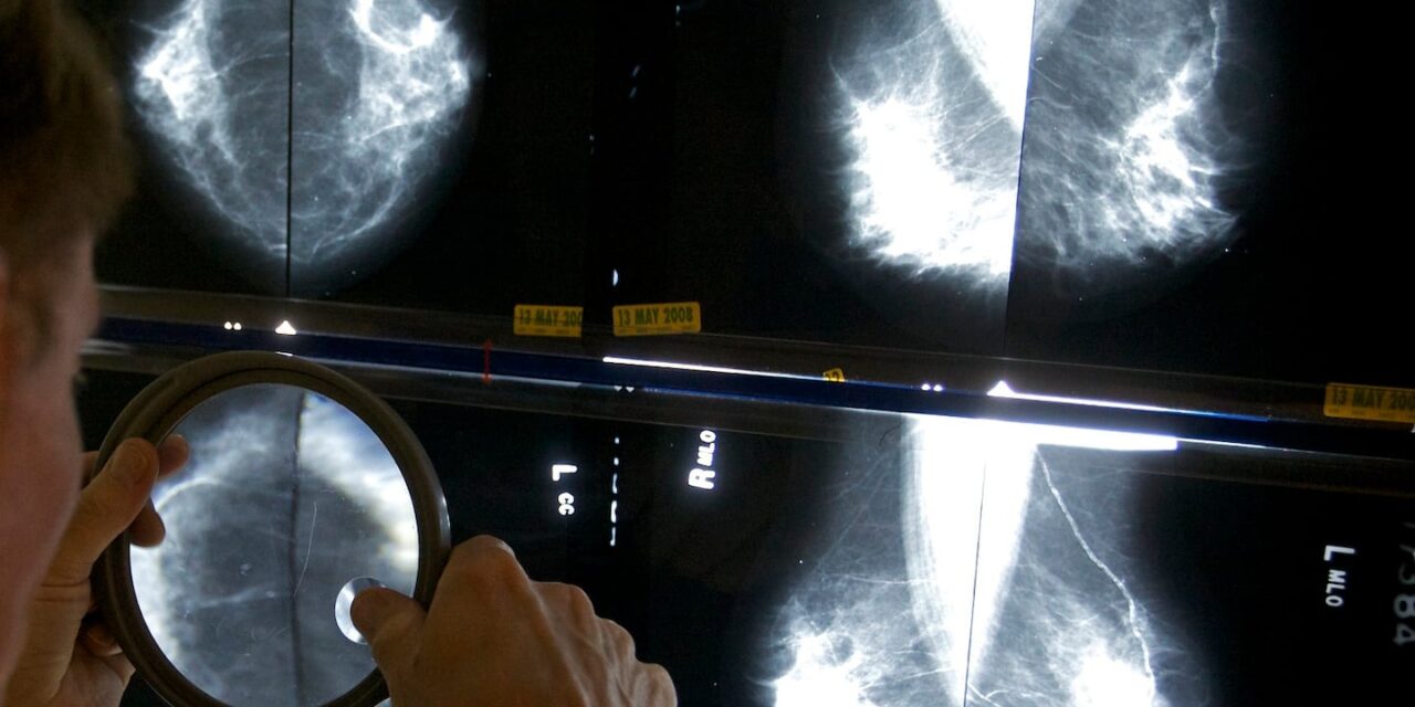Medical AI device found more breast cancer than doctors