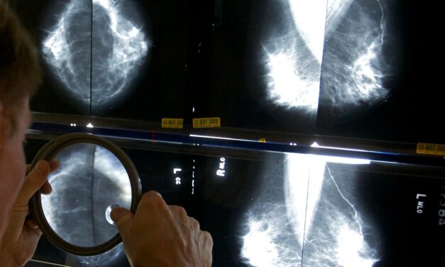Medical AI device found more breast cancer than doctors